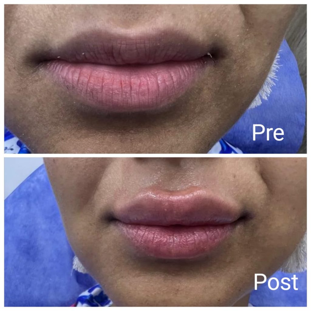 Hyaluronic for lips